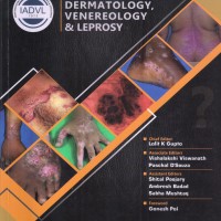 IADVL Multiple Choice Questions In Dermatology, Venereology and Leprosy by Lalit K Gupta