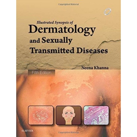 Illustrated Synopsis of Dermatology & Sexually Transmitted Diseases by Khanna Neena