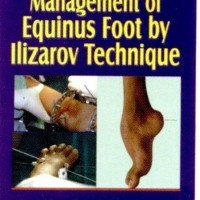 STEP BY STEP MANAGEMENT OF EQUINUS FOOT BY ILIZAROV TECHNIQUE WITH INT.CD ROM 1st Edition  (English, Paperback, AGRAWAL)