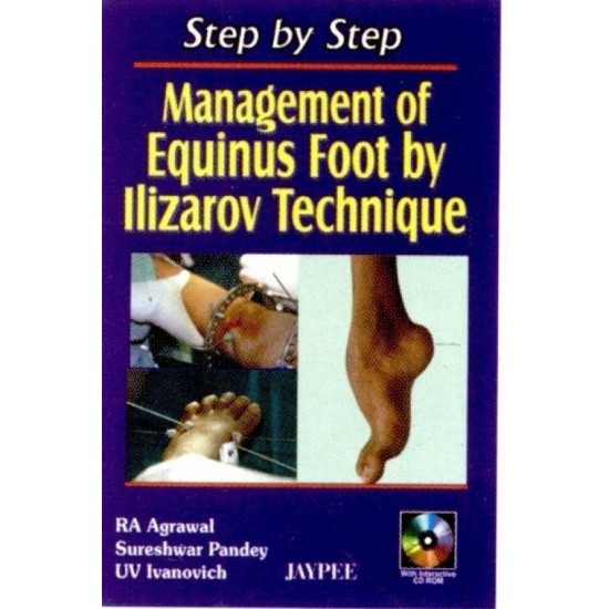 STEP BY STEP MANAGEMENT OF EQUINUS FOOT BY ILIZAROV TECHNIQUE WITH INT.CD ROM 1st Edition  (English, Paperback, AGRAWAL)